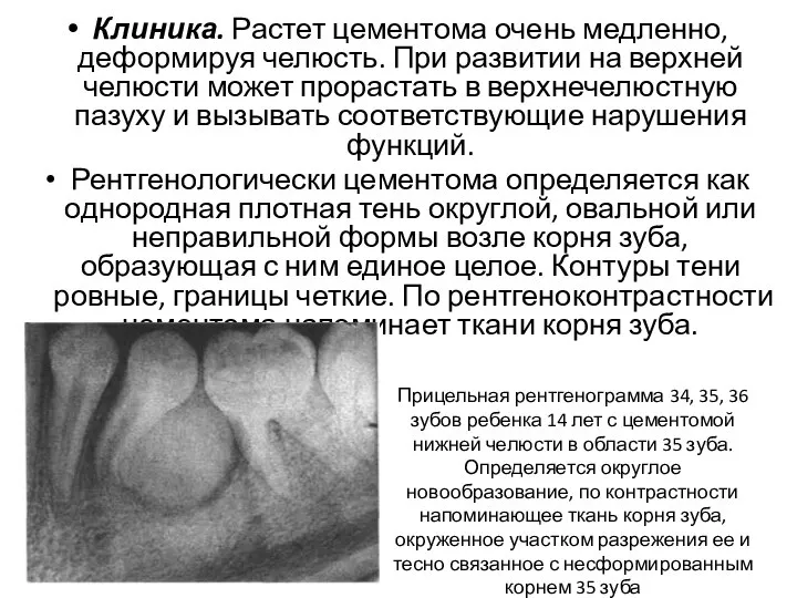 Клиника. Растет цементома очень медленно, деформируя челюсть. При развитии на верхней