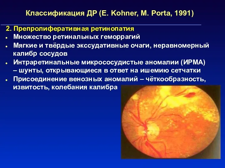 Классификация ДР (E. Kohner, M. Porta, 1991) 2. Препролиферативная ретинопатия Множество