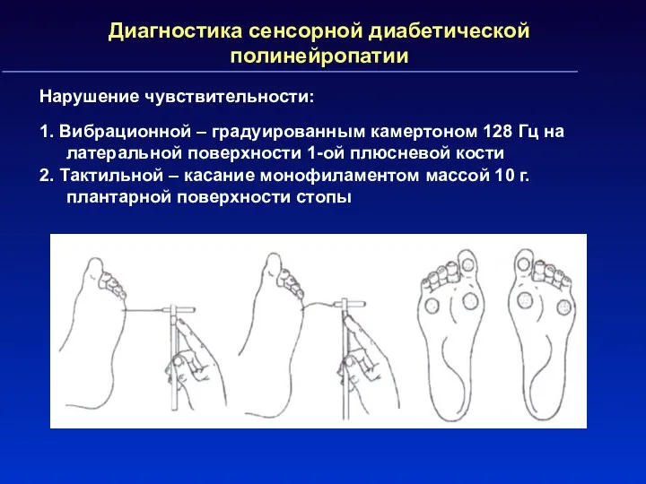 Диагностика сенсорной диабетической полинейропатии Нарушение чувствительности: 1. Вибрационной – градуированным камертоном