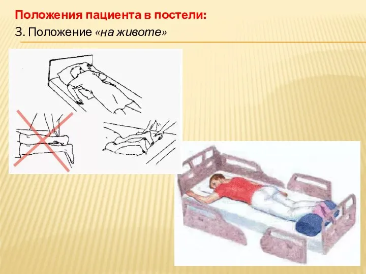 Положения пациента в постели: 3. Положение «на животе»