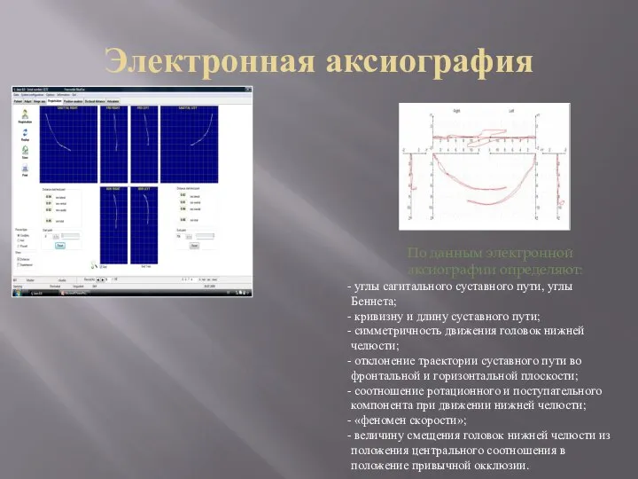 Электронная аксиография По данным электронной аксиографии определяют: углы сагитального суставного пути,