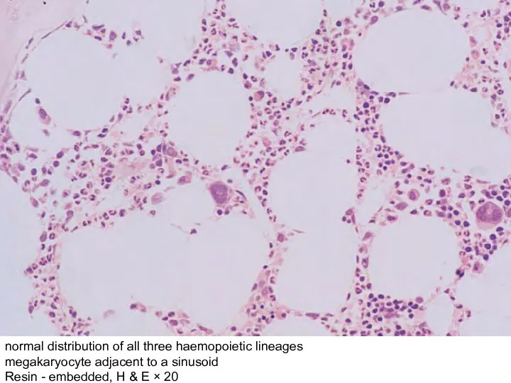 normal distribution of all three haemopoietic lineages megakaryocyte adjacent to a