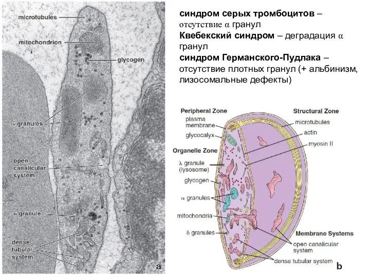 синдром серых тромбоцитов – отсутствие α гранул Квебекский синдром – деградация
