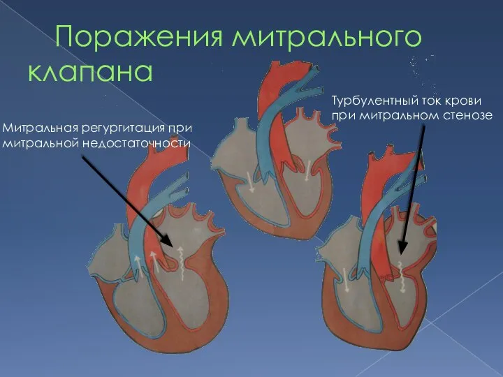 Поражения митрального клапана Митральная регургитация при митральной недостаточности Турбулентный ток крови при митральном стенозе