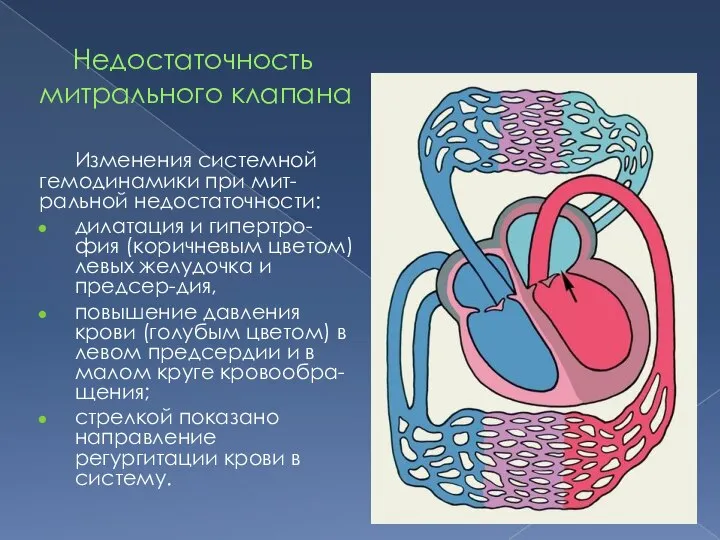 Недостаточность митрального клапана Изменения системной гемодинамики при мит-ральной недостаточности: дилатация и