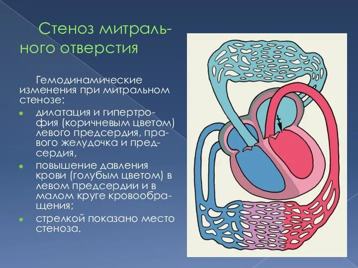 Стеноз митраль-ного отверстия Гемодинамические изменения при митральном стенозе: дилатация и гипертро-фия