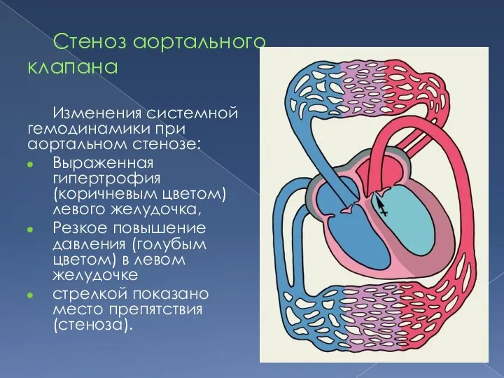 Стеноз аортального клапана Изменения системной гемодинамики при аортальном стенозе: Выраженная гипертрофия