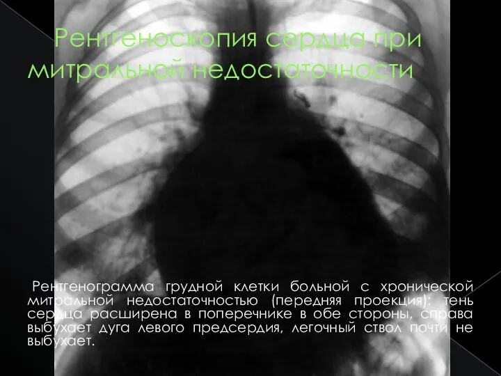Рентгеноскопия сердца при митральной недостаточности Рентгенограмма грудной клетки больной с хронической