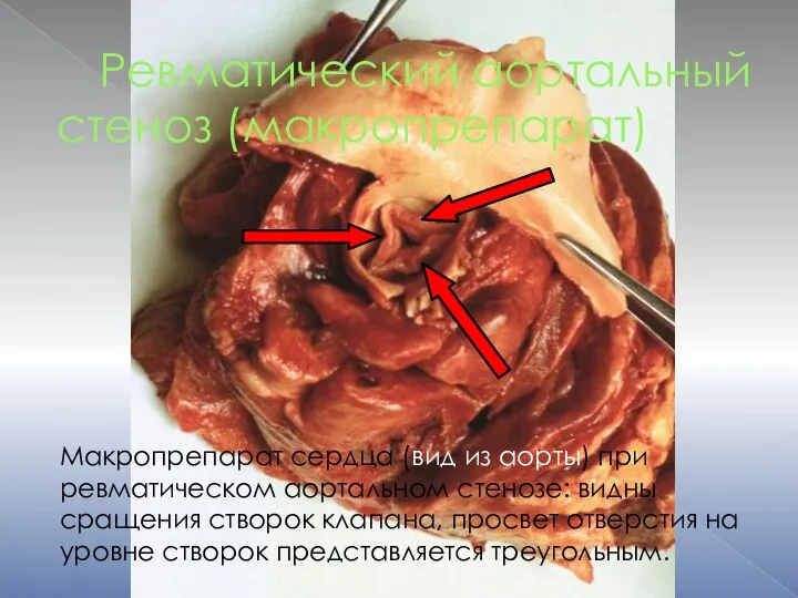 Ревматический аортальный стеноз (макропрепарат) Макропрепарат сердца (вид из аорты) при ревматическом