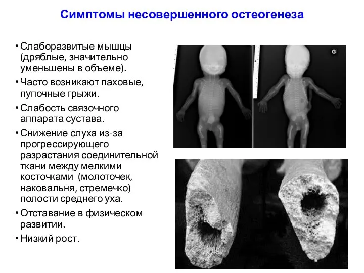 Симптомы несовершенного остеогенеза Слаборазвитые мышцы (дряблые, значительно уменьшены в объеме). Часто