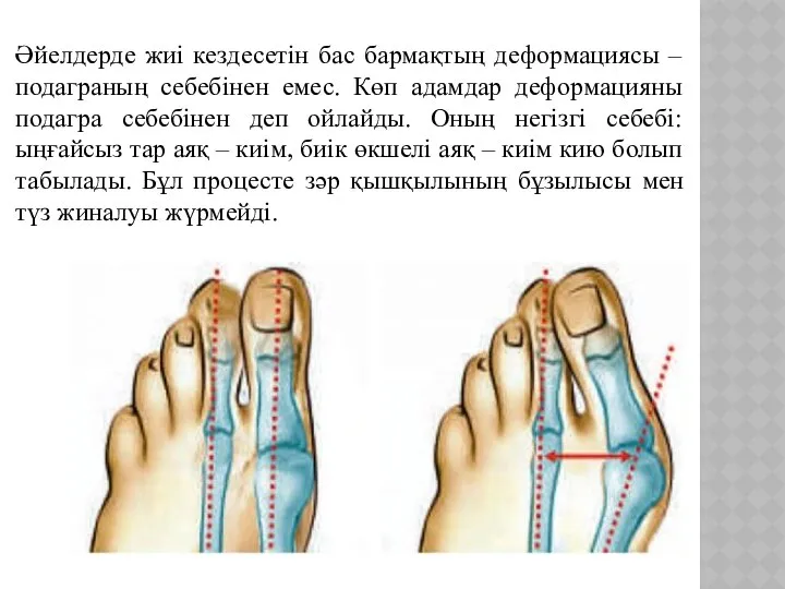 Әйелдерде жиі кездесетін бас бармақтың деформациясы – подаграның себебінен емес. Көп