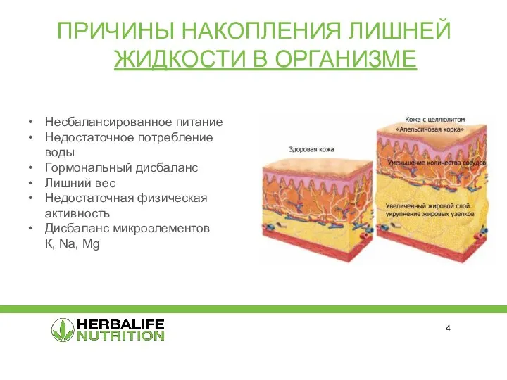 ПРИЧИНЫ НАКОПЛЕНИЯ ЛИШНЕЙ ЖИДКОСТИ В ОРГАНИЗМЕ Несбалансированное питание Недостаточное потребление воды