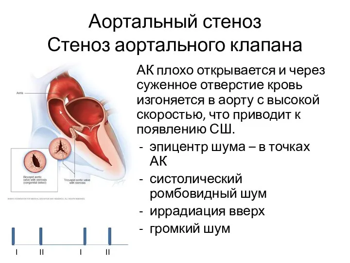 Аортальный стеноз Стеноз аортального клапана АК плохо открывается и через суженное