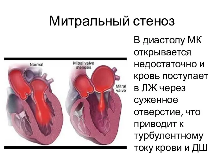 Митральный стеноз В диастолу МК открывается недостаточно и кровь поступает в