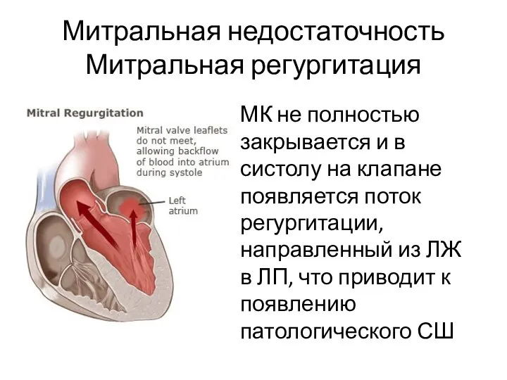 Митральная недостаточность Митральная регургитация МК не полностью закрывается и в систолу