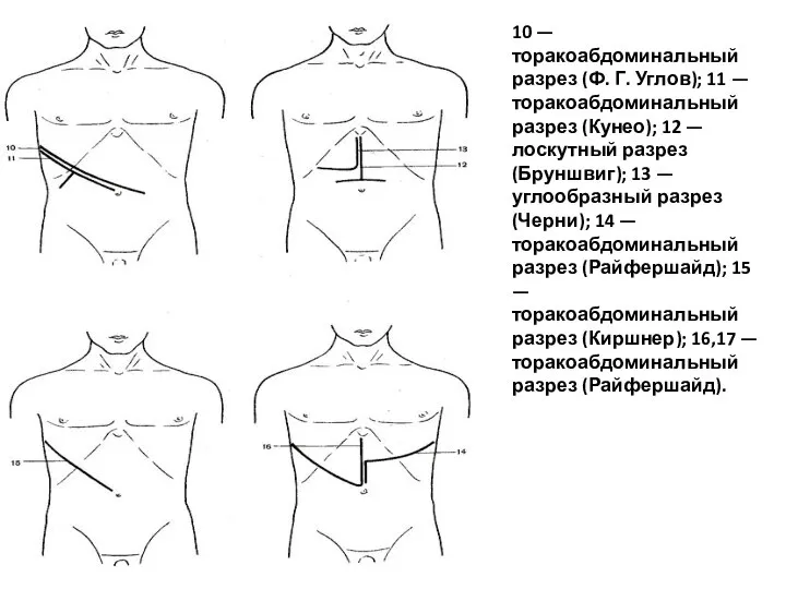 10 — торакоабдоминальный разрез (Ф. Г. Углов); 11 — торакоабдоминальный разрез