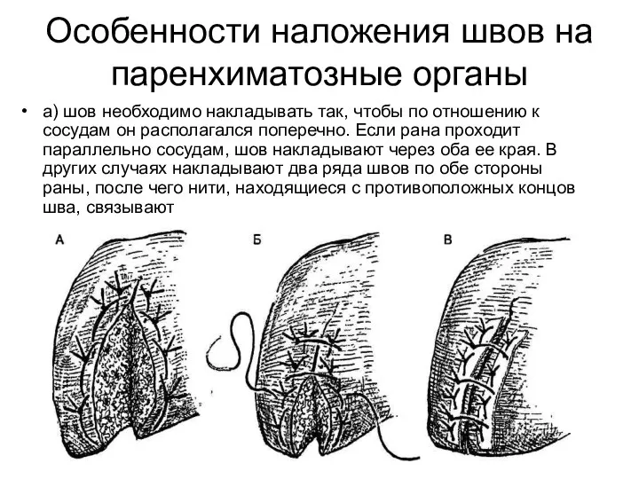 Особенности наложения швов на паренхиматозные органы а) шов необходимо накладывать так,