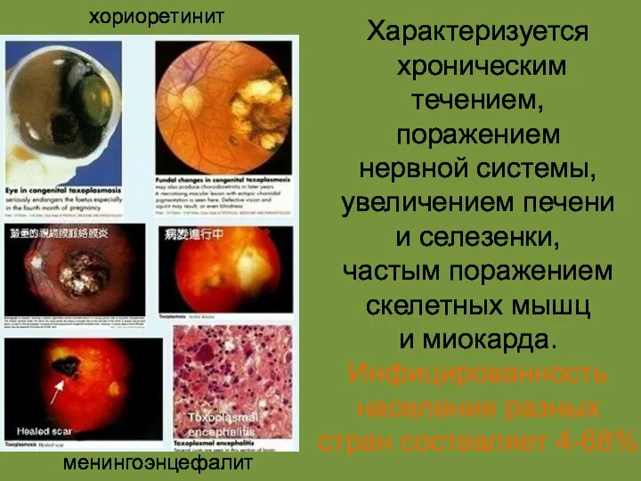 Характеризуется хроническим течением, поражением нервной системы, увеличением печени и селезенки, частым