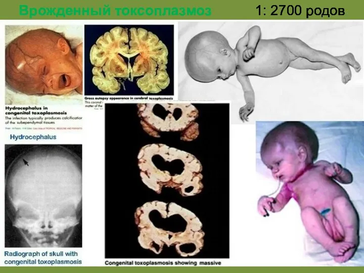 Врожденный токсоплазмоз 1: 2700 родов