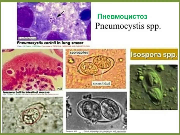 Пневмоцистоз