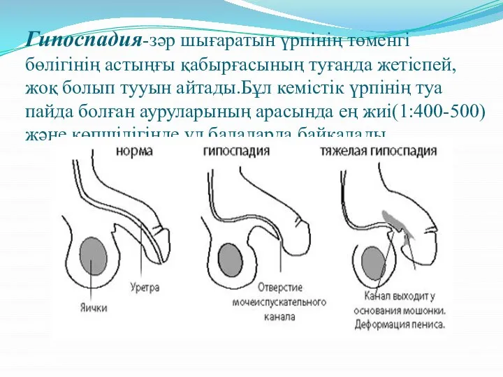 Гипоспадия-зәр шығаратын үрпінің төменгі бөлігінің астыңғы қабырғасының туғанда жетіспей,жоқ болып тууын