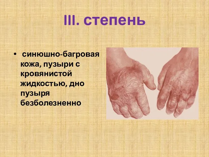 III. степень синюшно-багровая кожа, пузыри с кровянистой жидкостью, дно пузыря безболезненно