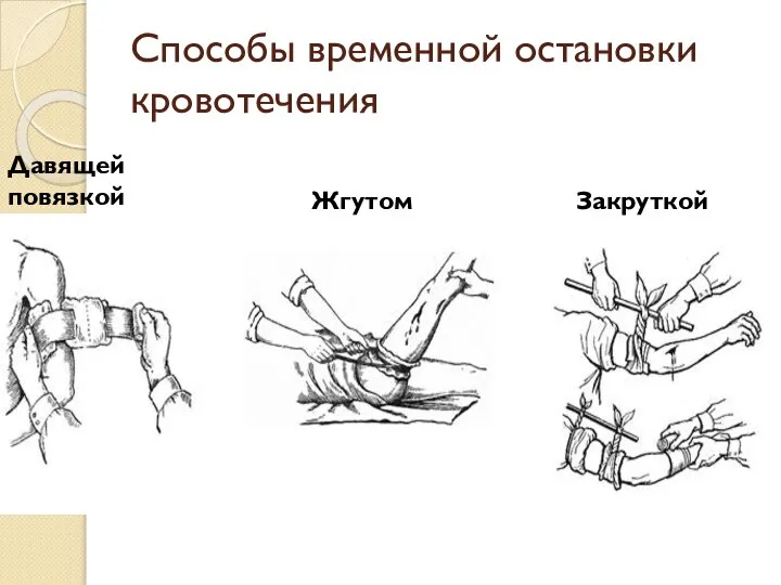 Способы временной остановки кровотечения Давящей повязкой Жгутом Закруткой