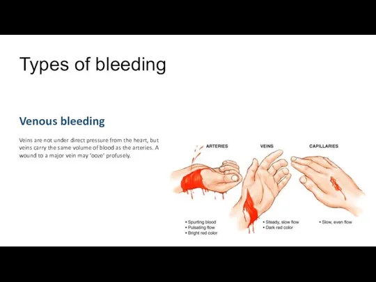 Types of bleeding Venous bleeding Veins are not under direct pressure