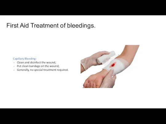 First Aid Treatment of bleedings. Capillary Bleeding: Clean and disinfect the