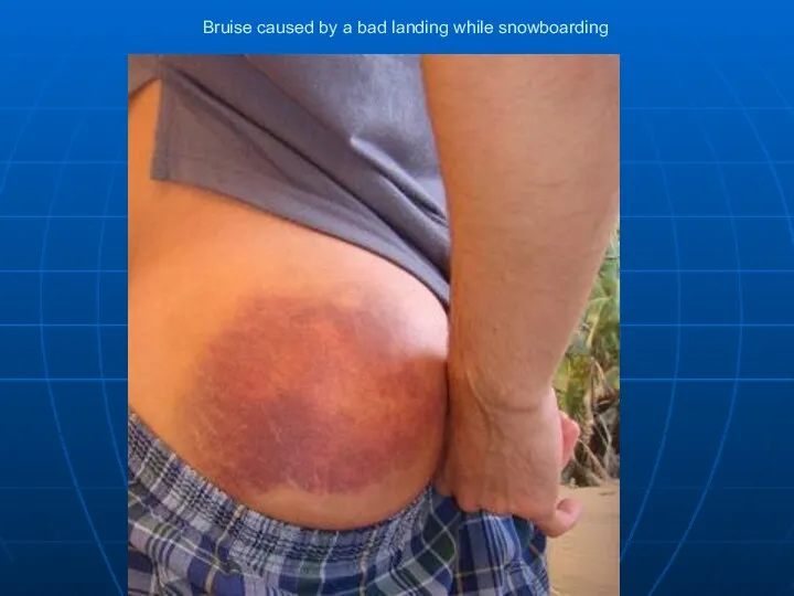 Bruise caused by a bad landing while snowboarding