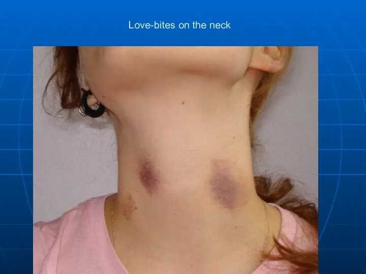 Love-bites on the neck