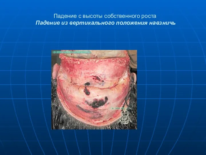 Падение с высоты собственного роста Падение из вертикального положения навзничь