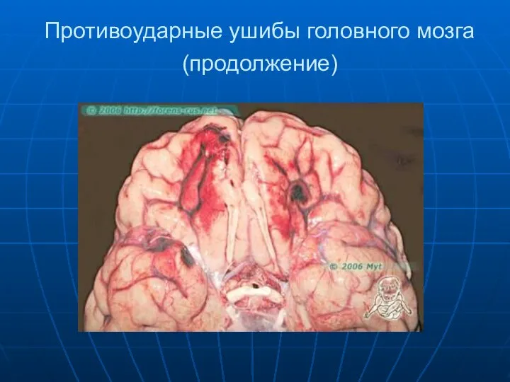 Противоударные ушибы головного мозга(продолжение)
