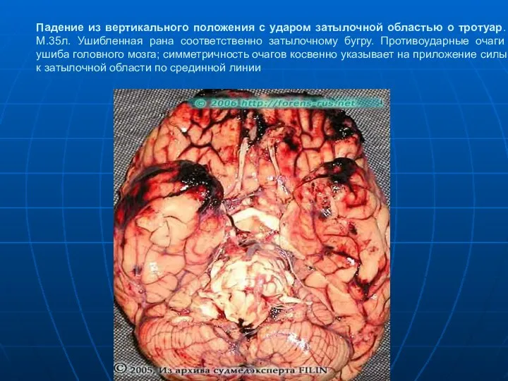 Падение из вертикального положения с ударом затылочной областью о тротуар. М.35л.