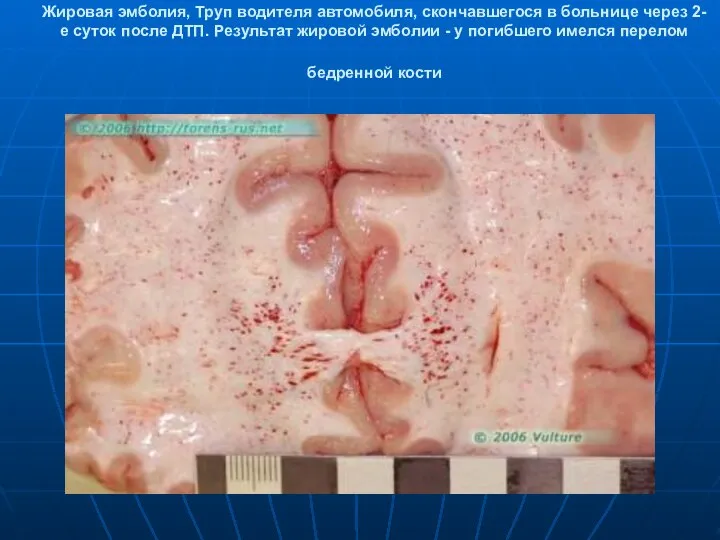 Жировая эмболия, Труп водителя автомобиля, скончавшегося в больнице через 2-е суток