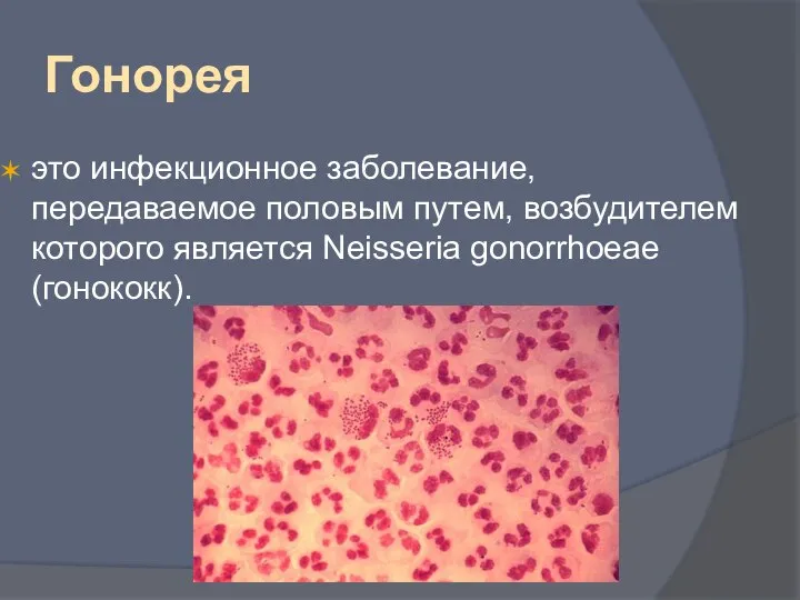 Гонорея это инфекционное заболевание, передаваемое половым путем, возбудителем которого является Neisseria gonorrhoeae (гонококк).