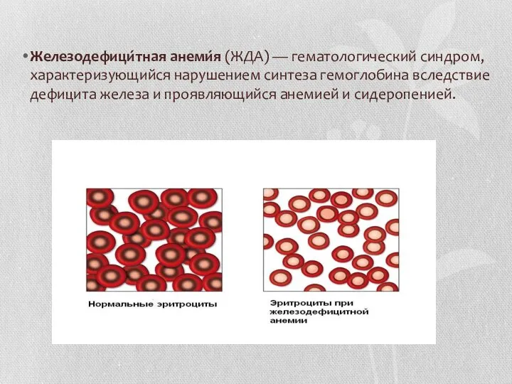 Железодефици́тная анеми́я (ЖДА) — гематологический синдром, характеризующийся нарушением синтеза гемоглобина вследствие