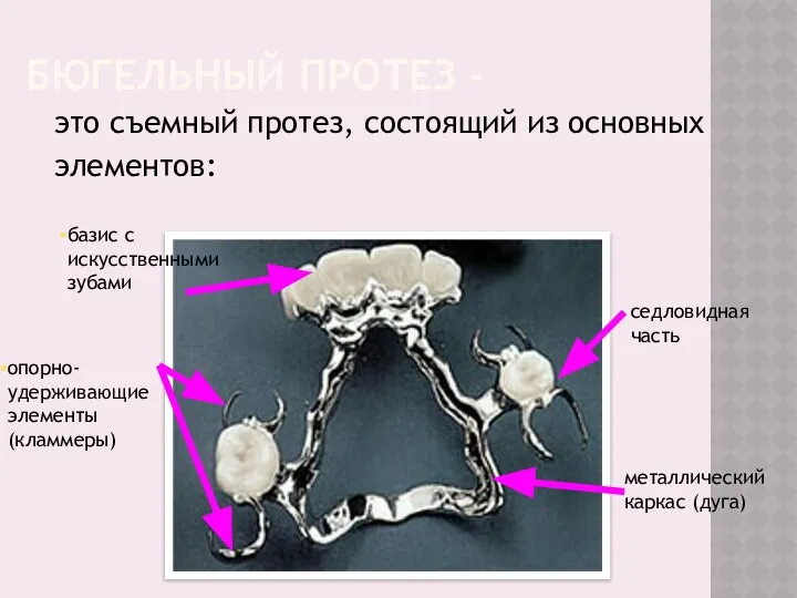 БЮГЕЛЬНЫЙ ПРОТЕЗ - это съемный протез, состоящий из основных элементов: металлический