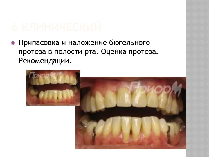 6 КЛИНИЧЕСКИЙ Припасовка и наложение бюгельного протеза в полости рта. Оценка протеза. Рекомендации.
