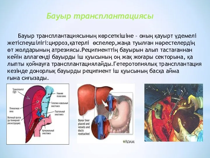 Бауыр трансплантациясы Бауыр трансплантациясының көрсеткішіне – оның қауырт үдемелі жетіспеушілігі:цирроз,қатерлі өспелер,жаңа