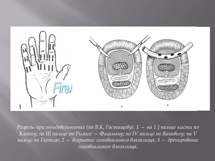 Разрезы при тендовагинитах (по В.К, Гостищеву). 1 — на 1 ]