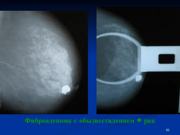 Фиброаденома с обызвествлением + рак