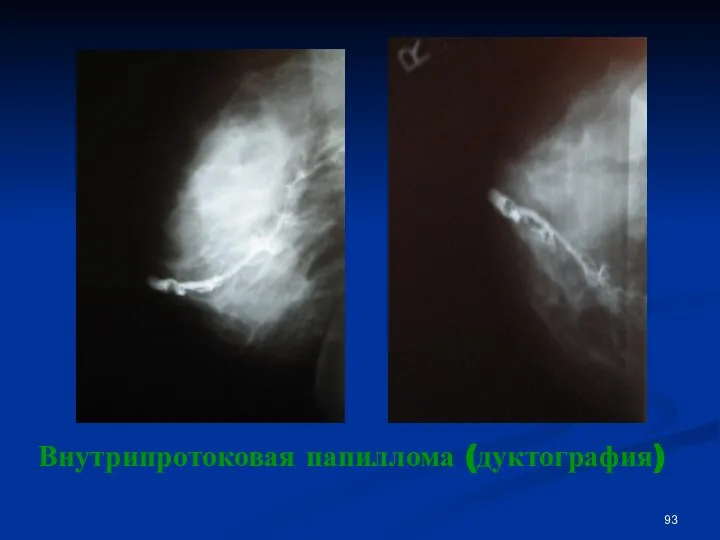 Внутрипротоковая папиллома (дуктография)
