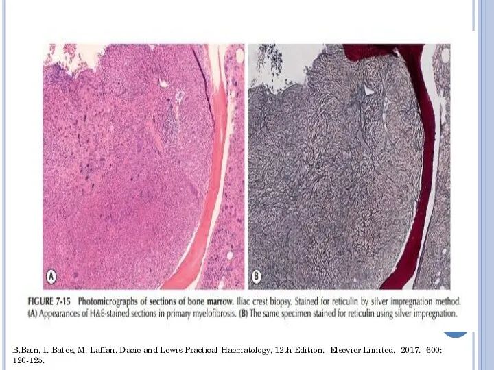 B.Bain, I. Bates, M. Laffan. Dacie and Lewis Practical Haematology, 12th