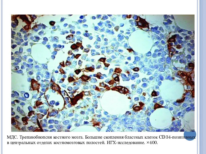 МДС. Трепанобиопсия костного мозга. Большие скопления бластных клеток CD34-позитивных в центральных отделах костномозговых полостей. ИГХ-исследование. ×400.
