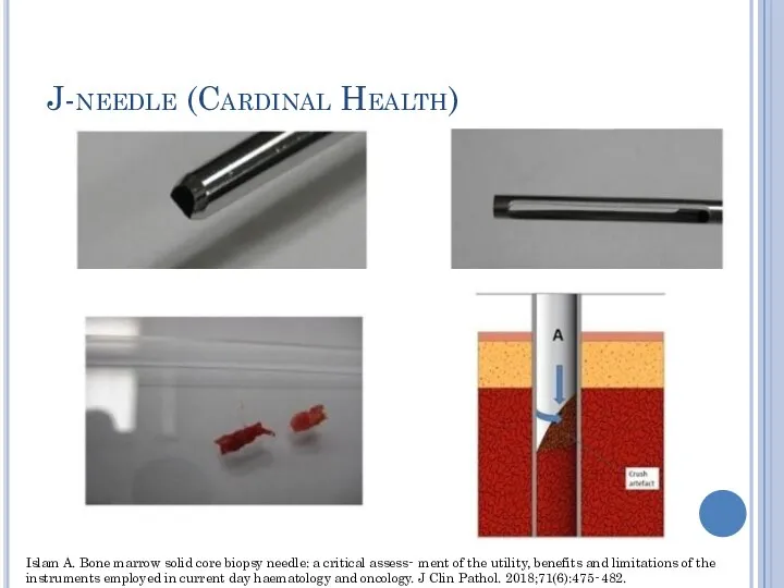 J-needle (Cardinal Health) Islam A. Bone marrow solid core biopsy needle: