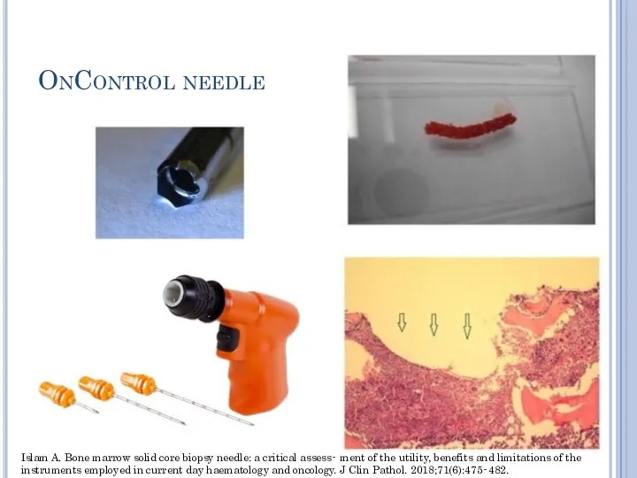 OnControl needle Islam A. Bone marrow solid core biopsy needle: a