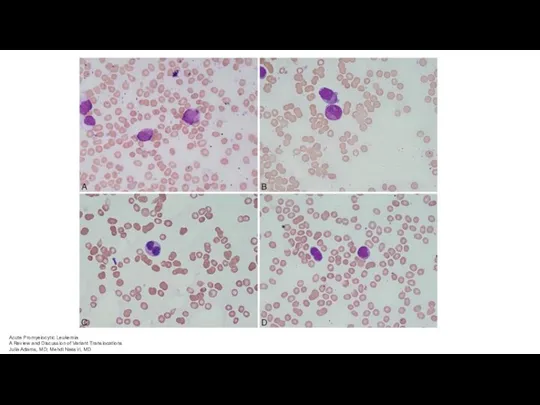 Acute Promyelocytic Leukemia A Review and Discussion of Variant Translocations Julia Adams, MD; Mehdi Nassiri, MD