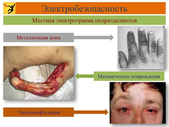 Местная электротравма подразделяются Электробезопасность Механические повреждения Металлизация кожи Электроофтальмия