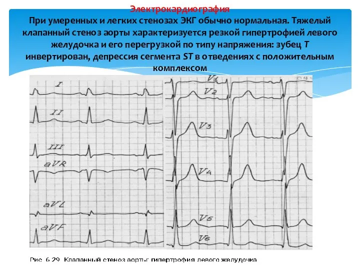 Электрокардиография При умеренных и легких стенозах ЭКГ обычно нормальная. Тяжелый клапанный